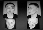 3D打印技术还原小伙正常的脸 - Syd.Com.Cn